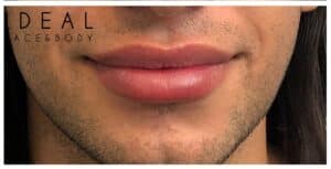Male Lip Augmentation | Painless