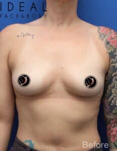 Breast Implant Augmentation