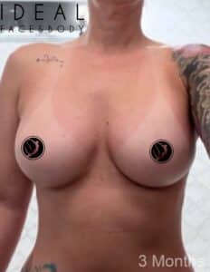 Breast Implant Augmentation