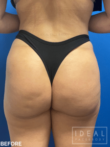 Cellulite Treatment | Aveli