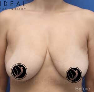 Awake Breast Lift® | Mastopexy