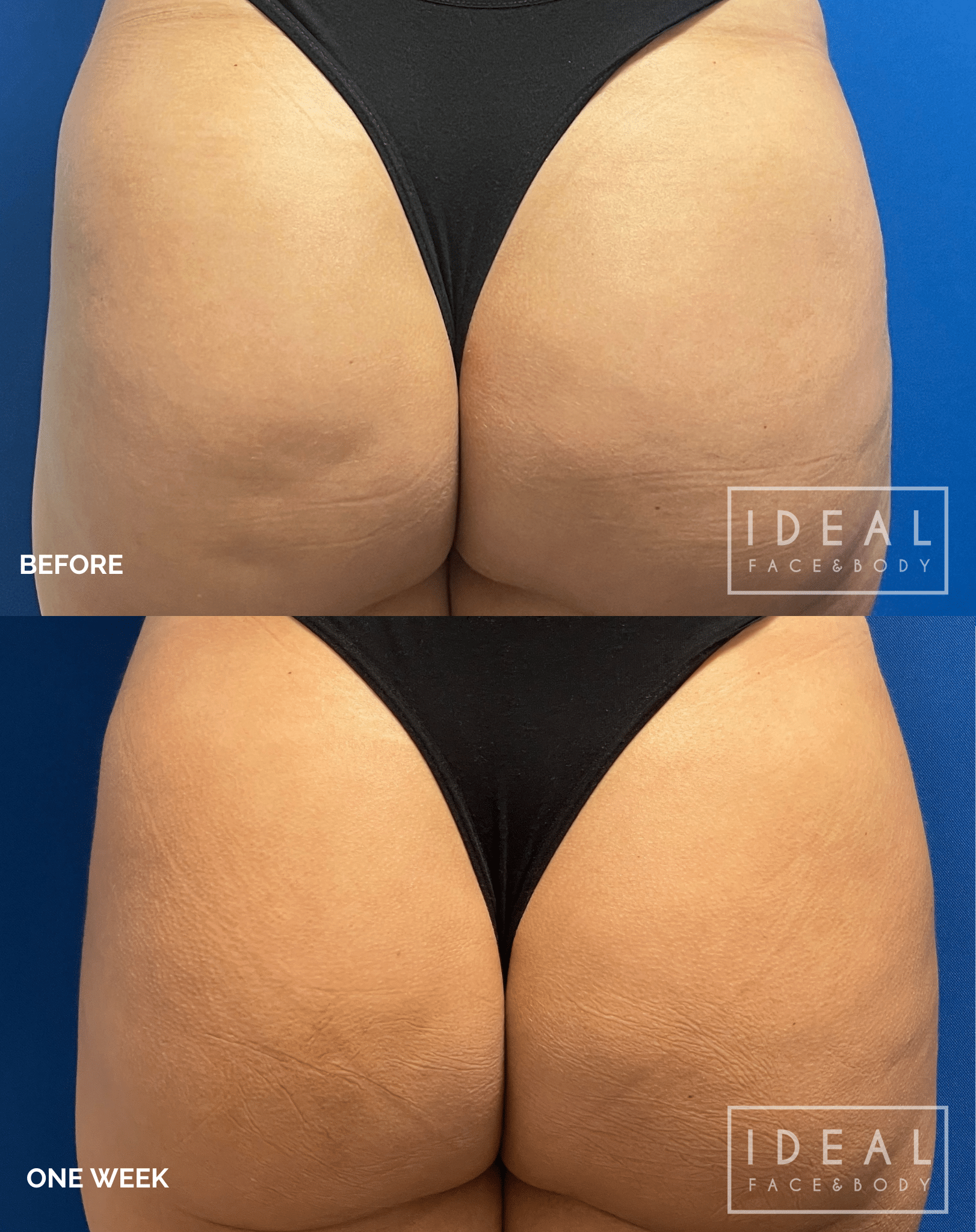 Before and one week after Aveli cellulite treatment