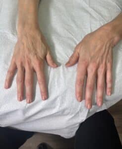 Before and After Renuva Injections To Hands | Fat Stimulator