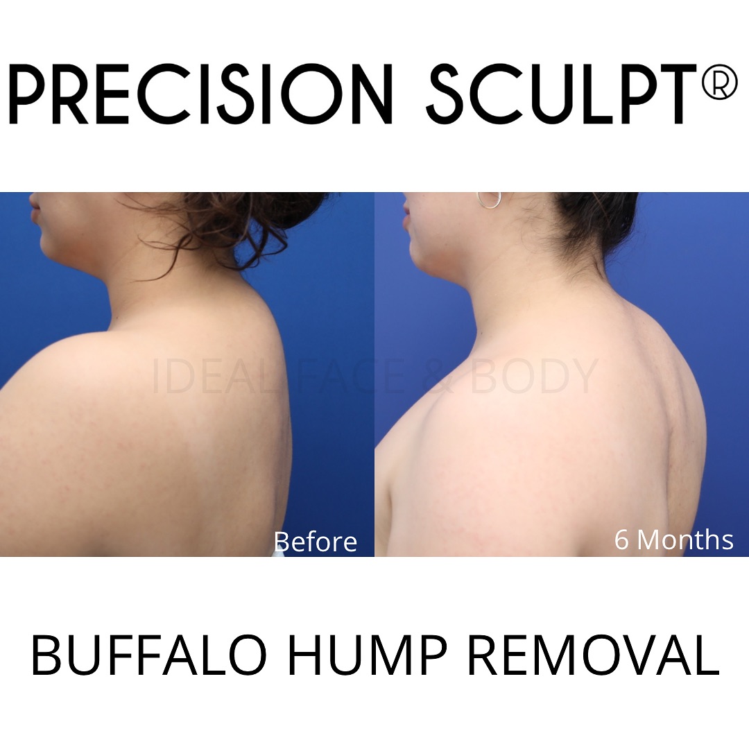 Can A Buffalo Hump Be Surgically Removed Top 5 Tips