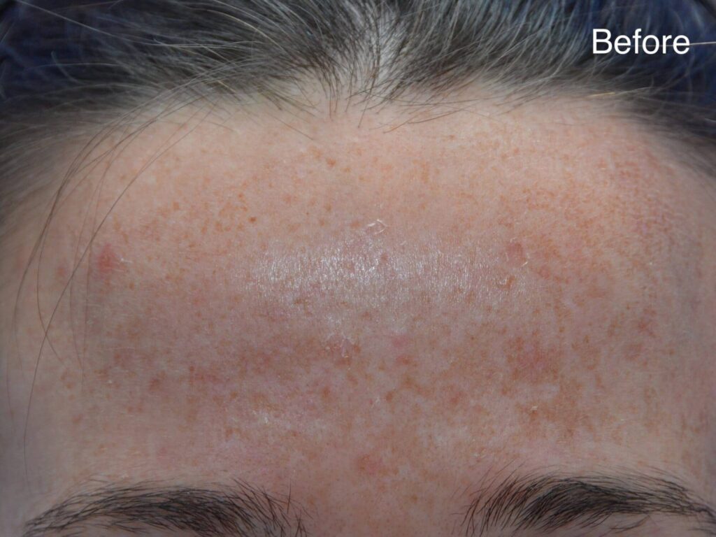 skin tightening after liposuction