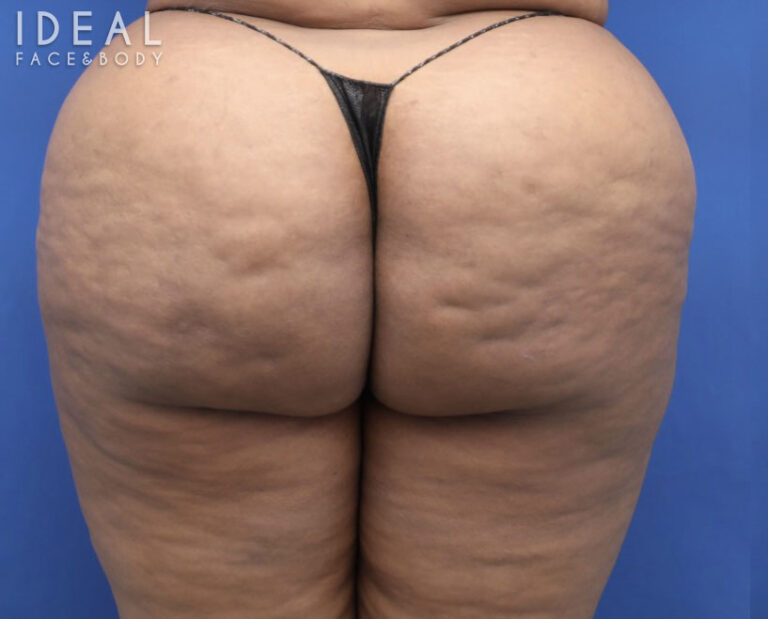 Before Image: BBL Reduction | Correction | Reversal | Awake Surgery - front