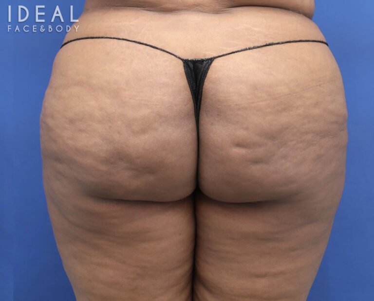 After Image: BBL Reduction | Correction | Reversal | Awake Surgery - front