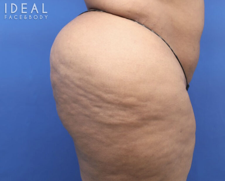 Before Image: BBL Reduction | Correction | Reversal | Awake Surgery - right-side