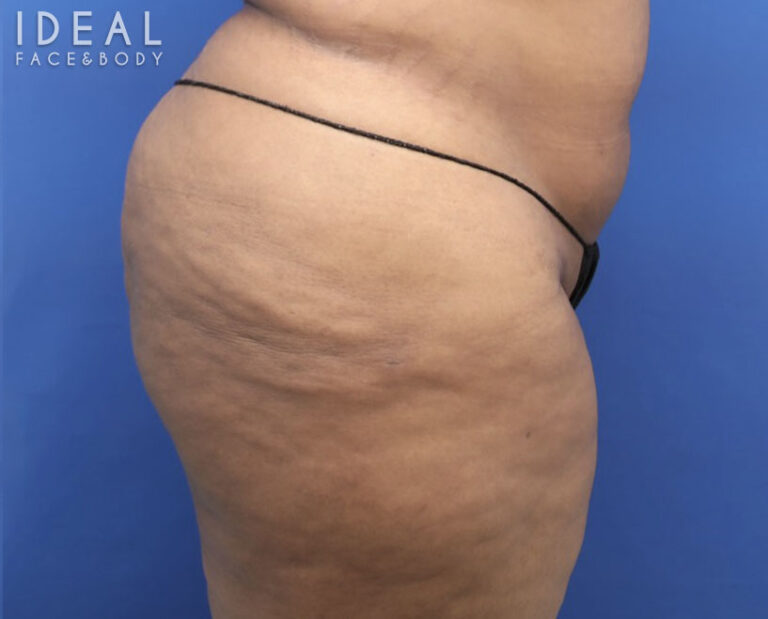After Image: BBL Reduction | Correction | Reversal | Awake Surgery - right-side