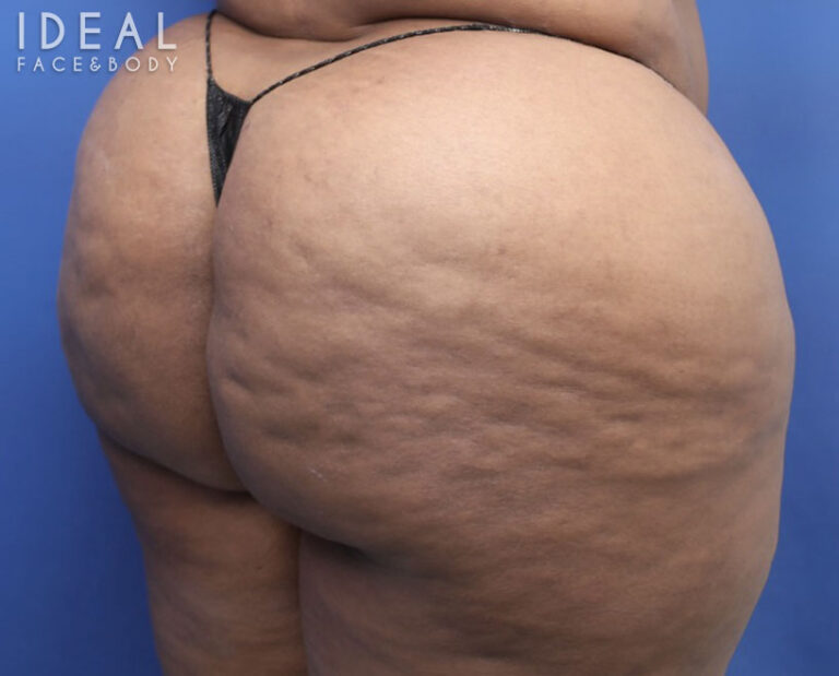 Before Image: BBL Reduction | Correction | Reversal | Awake Surgery - right-back-oblique