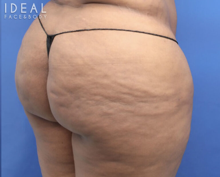 After Image: BBL Reduction | Correction | Reversal | Awake Surgery - right-back-oblique