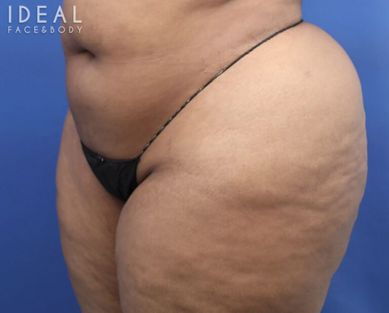 Before Image: BBL Reduction | Correction | Reversal | Awake Surgery - left-front-oblique