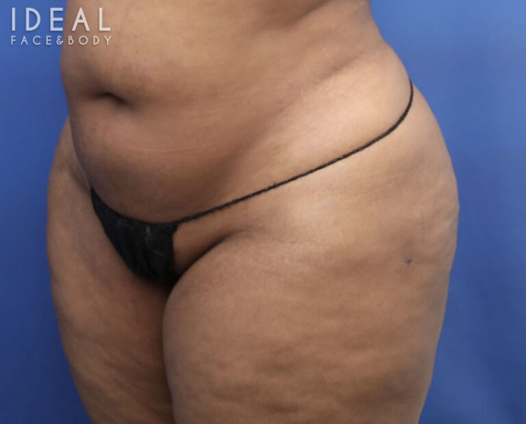 After Image: BBL Reduction | Correction | Reversal | Awake Surgery - left-front-oblique