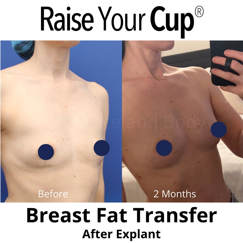 Breast Fat Transfer