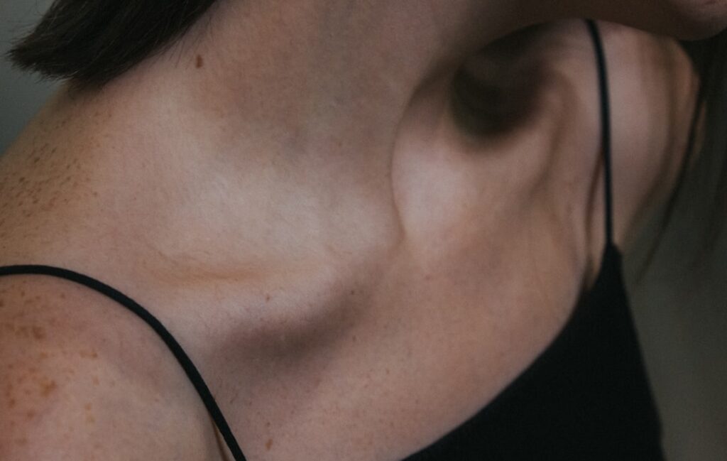 double chin liposuction