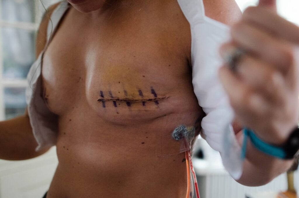 breast lift under local anesthesia