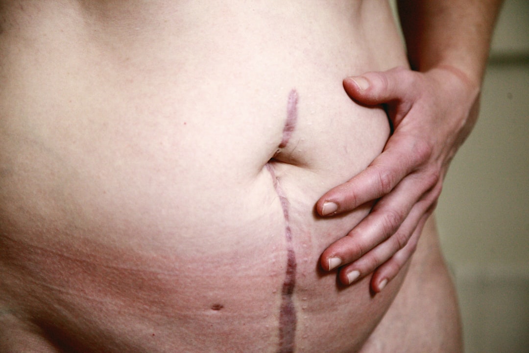 dorsocervical fat pad removal near me