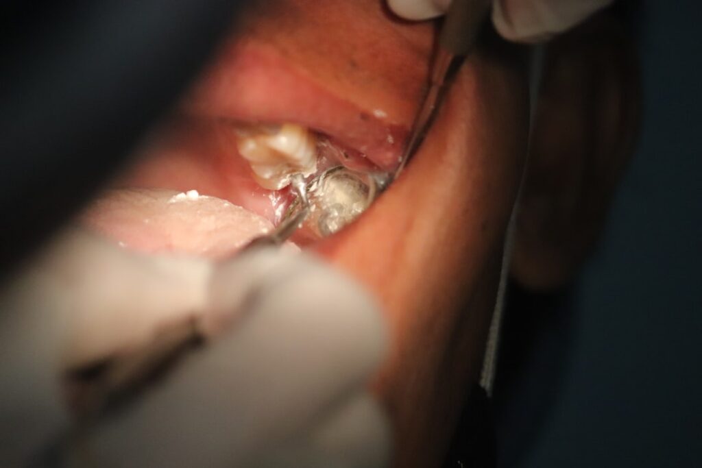 facelift under local anesthesia