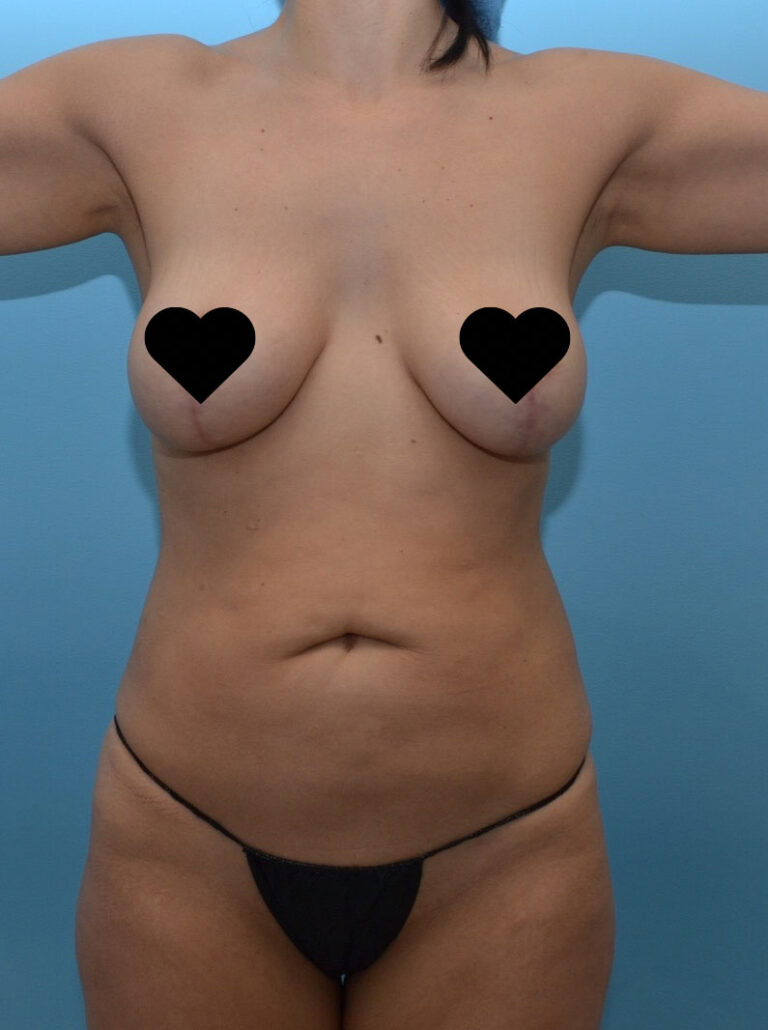 Before Image: Tummy Tuck | Abdominoplasty - front