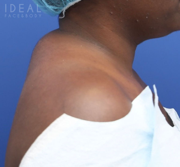 Before Image: Awake Buffalo Hump Removal | PRECISION SCULPT® - right-side
