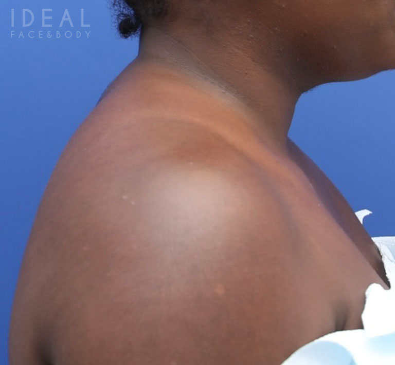 After Image: Awake Buffalo Hump Removal | PRECISION SCULPT® - right-side