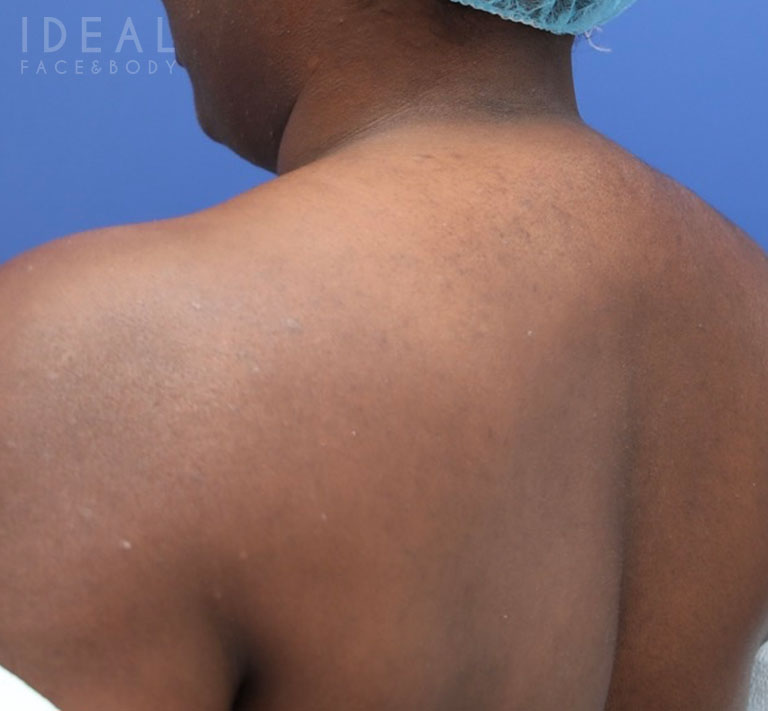 Before Image: Awake Buffalo Hump Removal | PRECISION SCULPT® - left-back-oblique