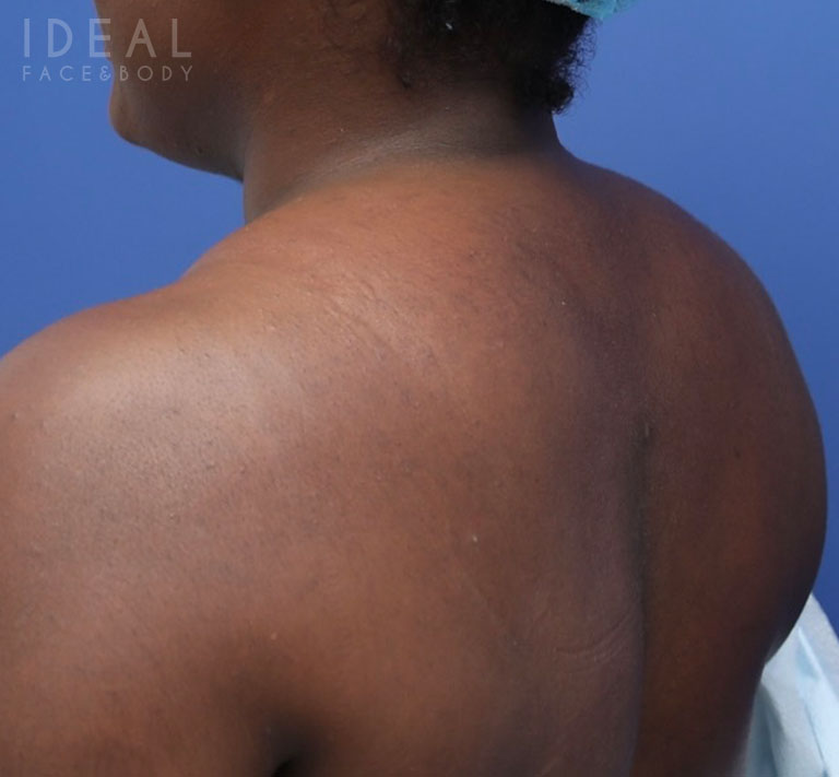 After Image: Awake Buffalo Hump Removal | PRECISION SCULPT® - left-back-oblique