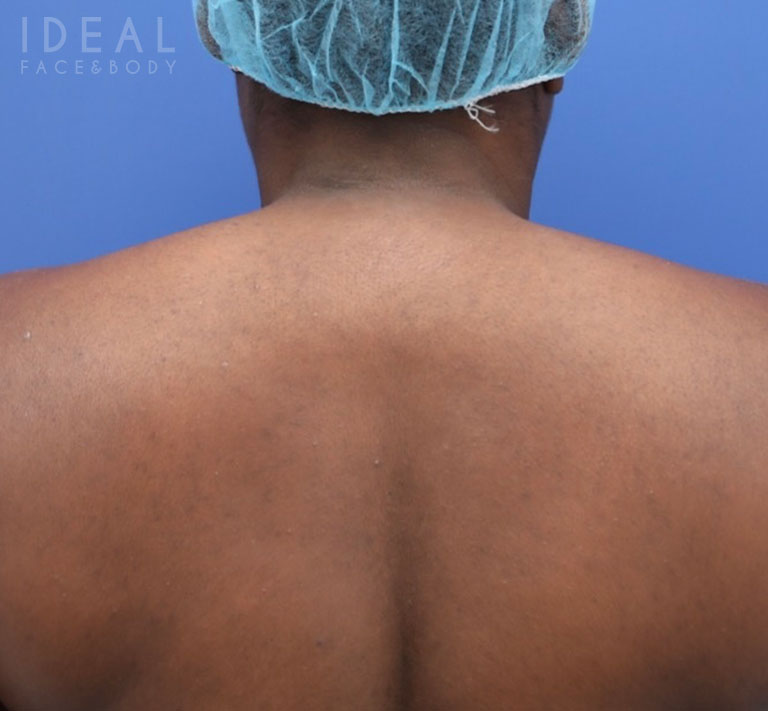 Before Image: Awake Buffalo Hump Removal | PRECISION SCULPT® - back