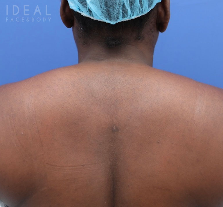 After Image: Awake Buffalo Hump Removal | PRECISION SCULPT® - back