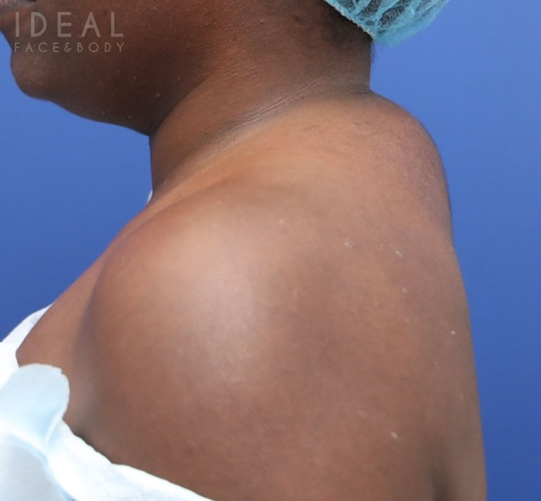 Before Image: Awake Buffalo Hump Removal | PRECISION SCULPT® - left-side