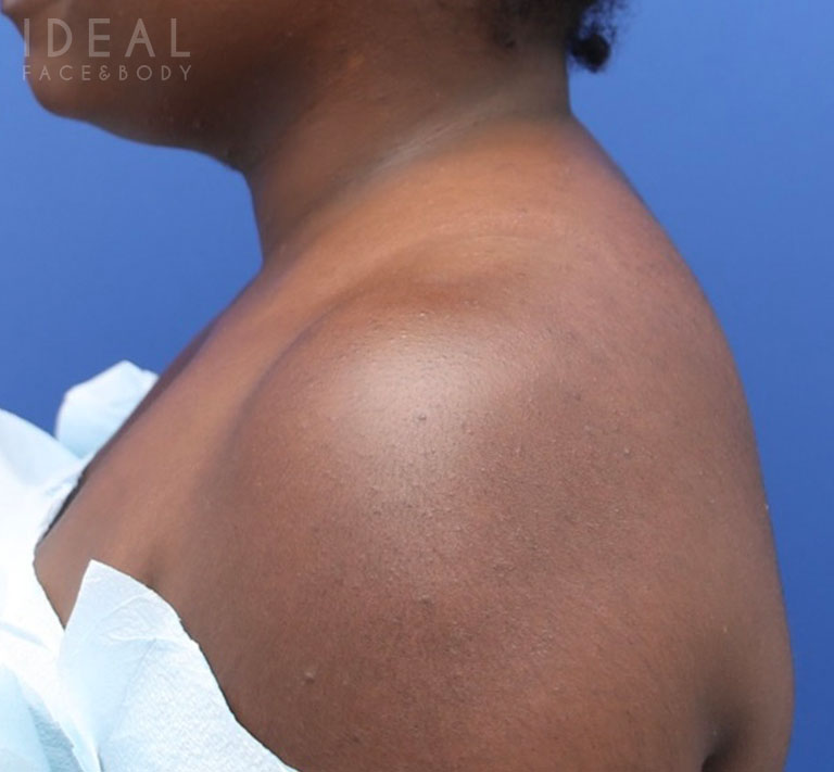 After Image: Awake Buffalo Hump Removal | PRECISION SCULPT® - left-side