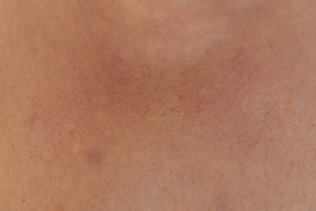 acne scar treatment