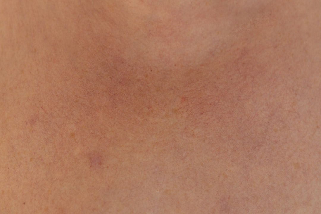 acne scar treatment