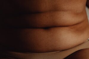 awake tummy tuck