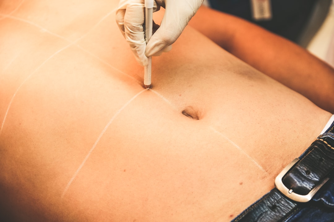 Laser tattoo removal benefits