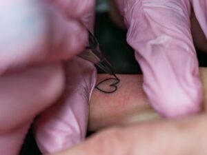 Laser tattoo removal prices