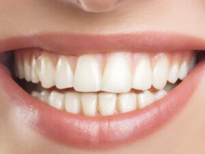 lip augmentation before after