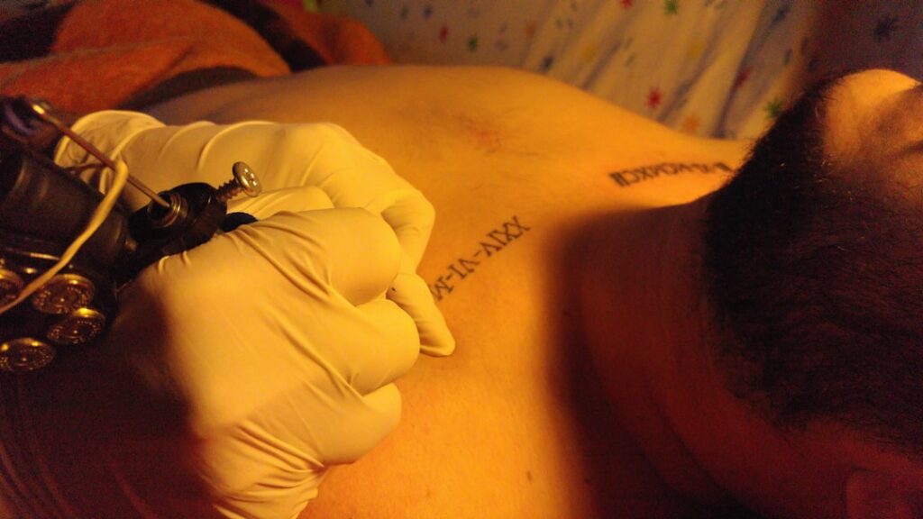 Tattoo removal Los Angeles