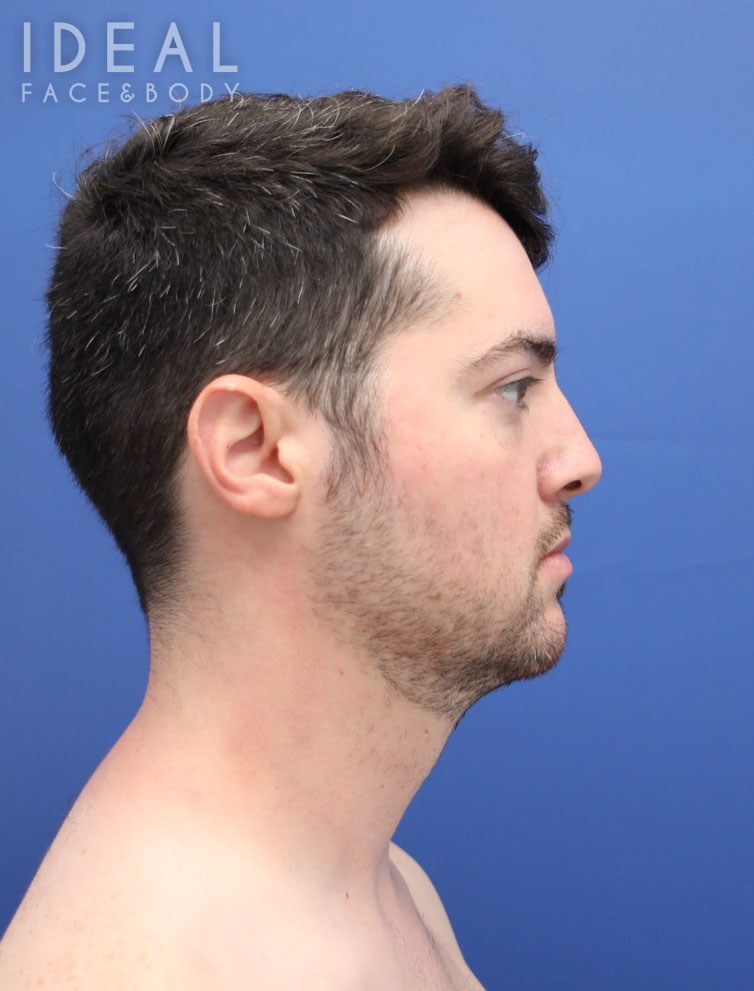 Before Image: Awake Chin, Neck, & Jawline Liposculpting | PRECISION SCULPT® - right-side