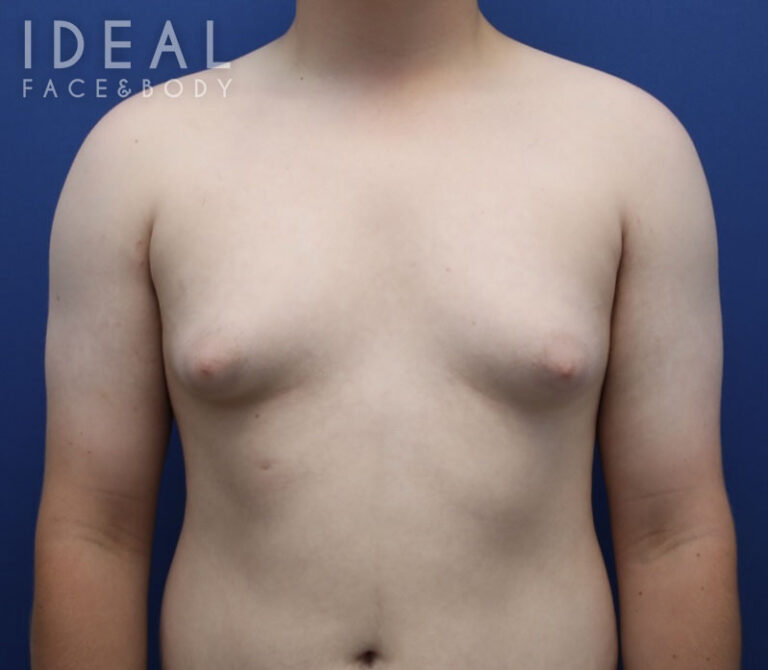 Before Image: Awake Male Chest Liposuction / Gynecomastia Surgery - front