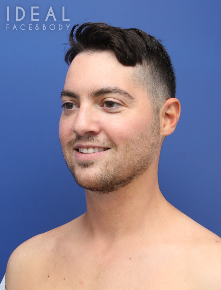 After Image: Awake Chin, Neck, & Jawline Liposculpting | PRECISION SCULPT® - left-front-oblique
