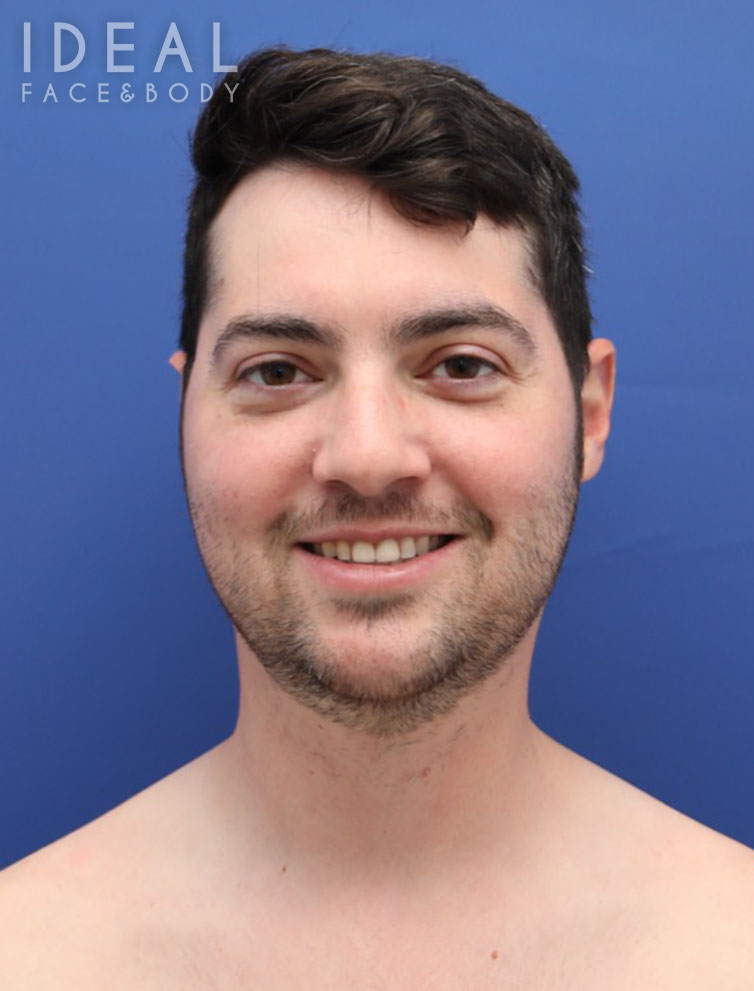 Before Image: Awake Chin, Neck, & Jawline Liposculpting | PRECISION SCULPT® - front