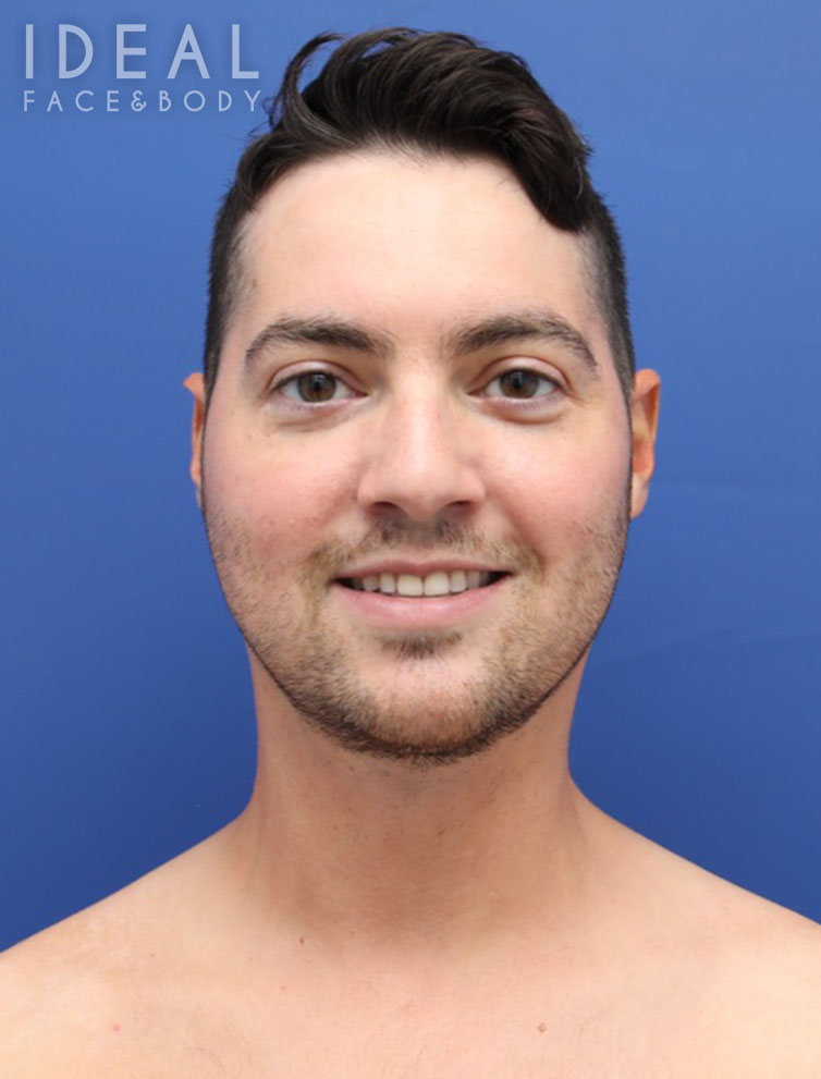 After Image: Awake Chin, Neck, & Jawline Liposculpting | PRECISION SCULPT® - front