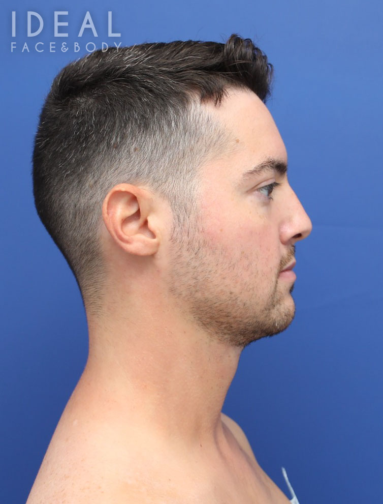 After Image: Awake Chin, Neck, & Jawline Liposculpting | PRECISION SCULPT® - right-side