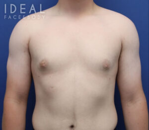 After Image: Awake Male Chest Liposuction / Gynecomastia Surgery