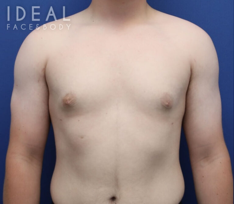 After Image: Awake Male Chest Liposuction / Gynecomastia Surgery - front