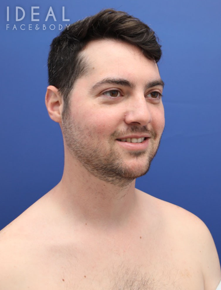 Before Image: Awake Chin, Neck, & Jawline Liposculpting | PRECISION SCULPT® - right-front-oblique