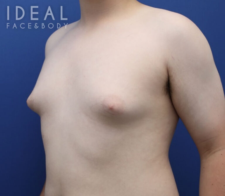 Before Image: Awake Male Chest Liposuction / Gynecomastia Surgery - left-front-oblique