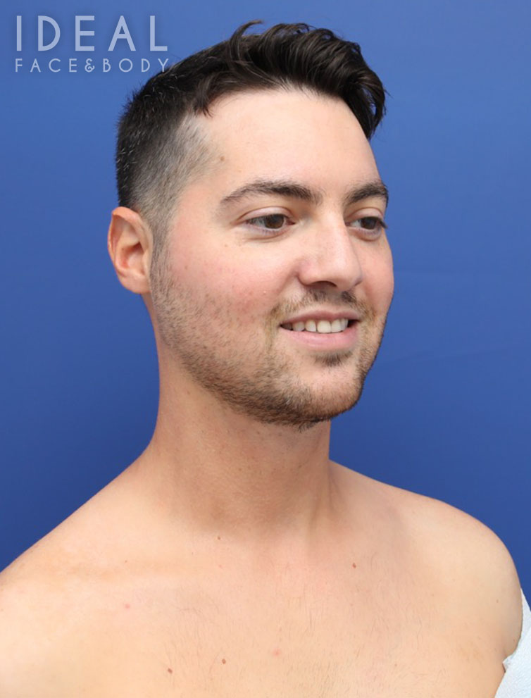 After Image: Awake Chin, Neck, & Jawline Liposculpting | PRECISION SCULPT® - right-front-oblique