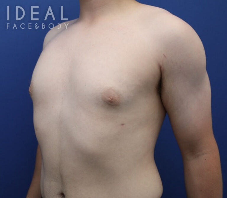 After Image: Awake Male Chest Liposuction / Gynecomastia Surgery - left-front-oblique